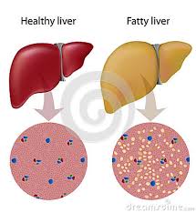 کبد چرب را بشناسید