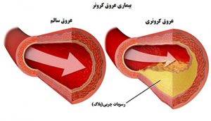 گرفتگی عروق قلب