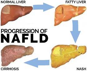 نگاهی کلی بر بیماری کبد چرب غیر الکلی