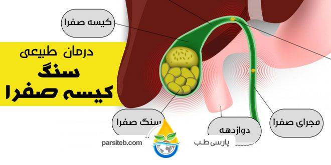 سنگ کیسه صفرا با این 9 روش درمان می شود