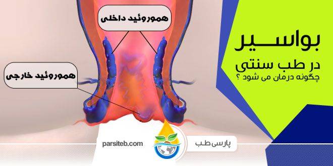 بواسیر ( هموروئید ) در طب سنتی چگونه درمان می شود ؟