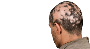زالودرمانی برای درمان آلوپسی و ریزش موی سکه ای ALOPECIA