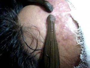 زالودرمانی برای درمان آلوپسی و ریزش موی سکه ای