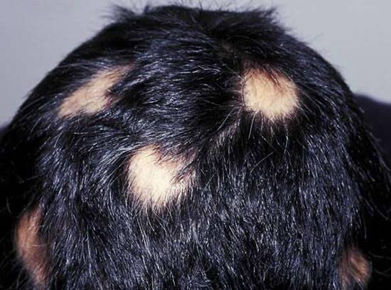 ریزش موی سکه‌ای از تشخیص تا درمان