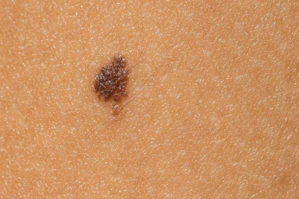 15 باور غلط درباره سرطان پوست