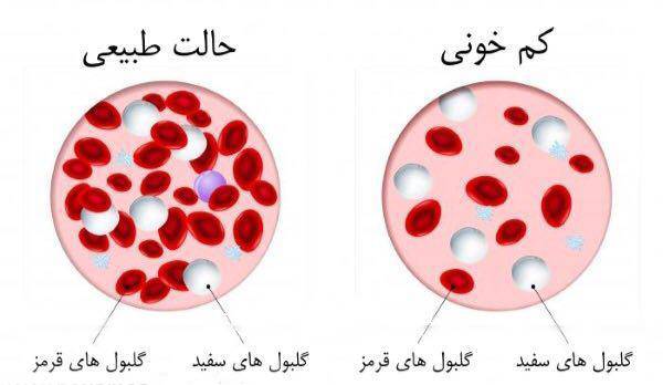 علل، انواع و روش‌های درمان کم خونی