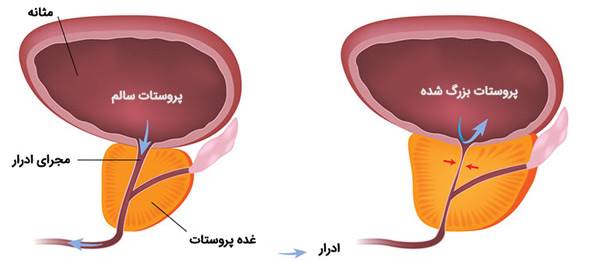 علائم بزرگ شدن غیرطبیعی پروستات