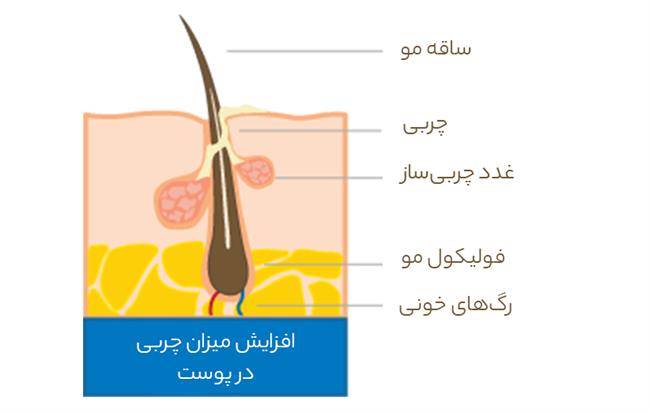 یک روش موثر برای از بین بردن جوش صورت و آکنه