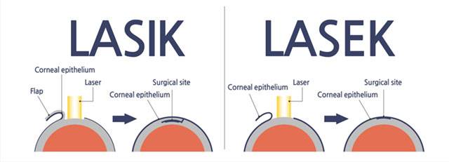 لازک یا لیزیک، کدام بهتر است؟