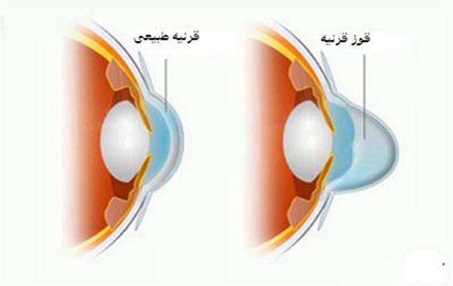 راهکار‌های درمان قوز قرنیه
