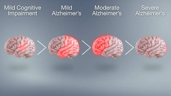 بیماری آلزایمر