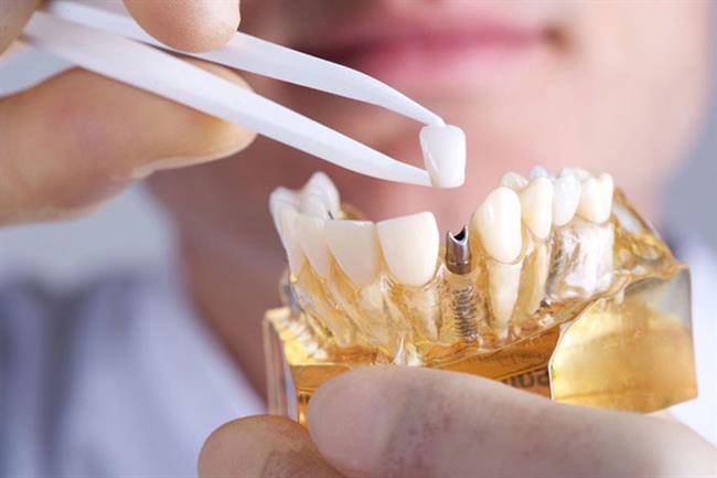 ایمپلنت دندان - مراحل