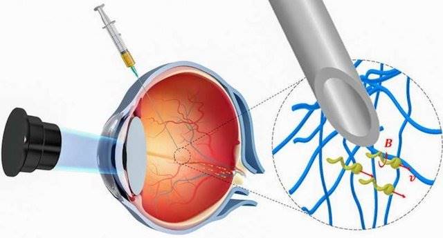 دارورسانی مستقیم از چشم توسط ربات‌های کوچک