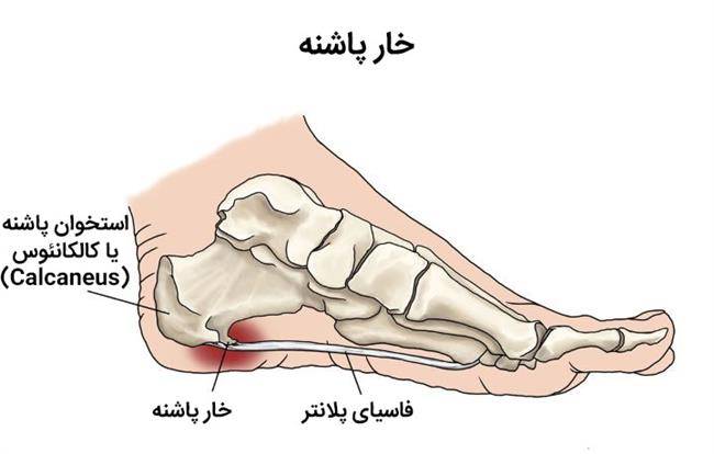 خار پاشنه چیست - نمایی از پهلوی پا