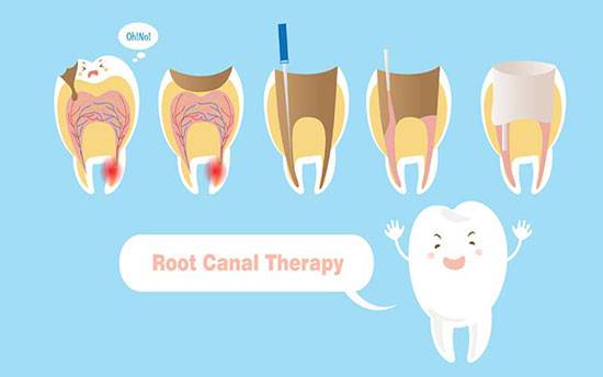 پاسخ به 7 سوال رایج درباره عصب کشی دندان