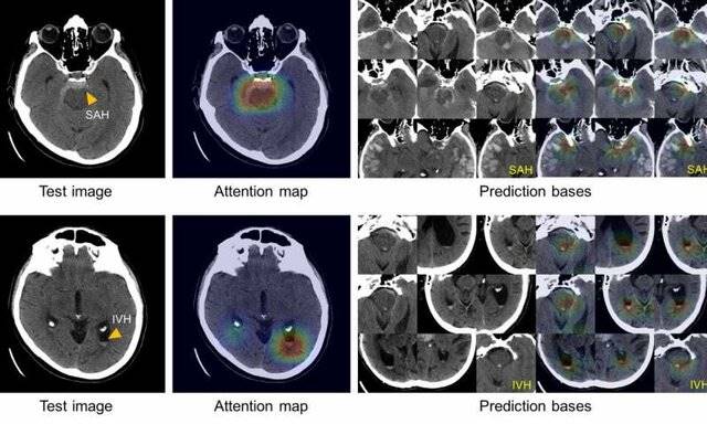 سیستم هوش مصنوعی‌ خونریزی درون جمجمه‌ای را شناسایی می‌کند
