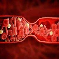افزایش ریسک تصلب شریان در افراد میانسال