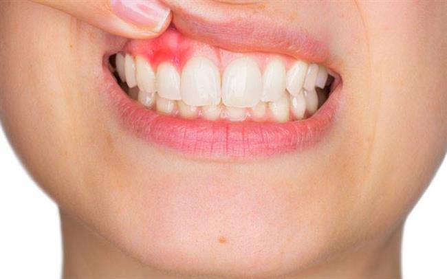 عفونت دندان - لثه‌ها