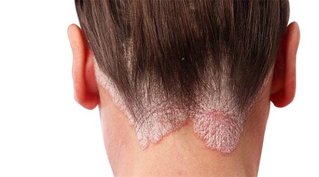 درمان پسوریازیس پوست سر با دارو و روش های خانگی