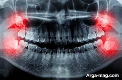 برای تسکین درد دندان عقل از این راهکارها استفاده کنید