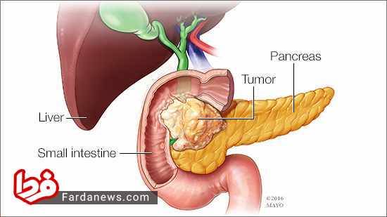 علائم سرطان لوزالمعده / نشانه‌های سرطان پانکراس