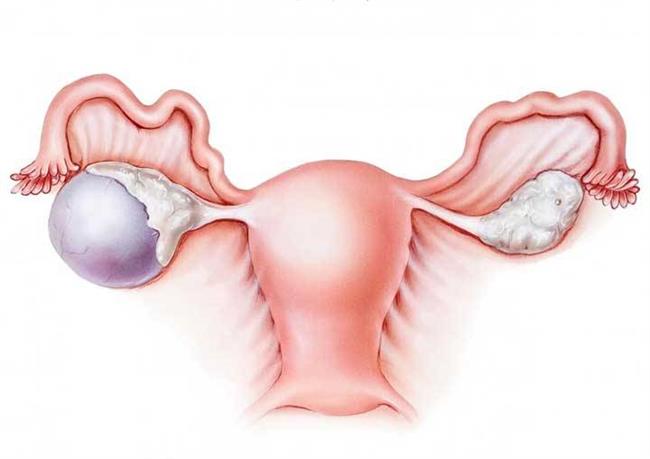 درمان کیست تخمدان - اقدامات فوری