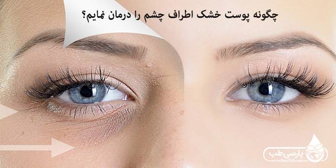 چگونه پوست خشک اطراف چشم را درمان نمایم؟