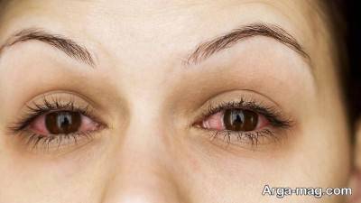 علائم عفونت چشم