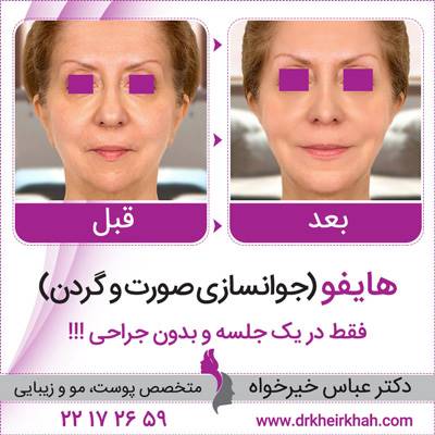 قرن جوانسازی بدون جراحی (لیفتینگ با نخ)