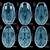 تشخیص افکار منجر به خودکشی با اسکن مغز