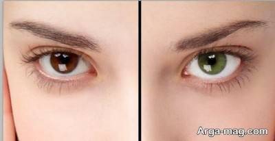 تغییر رنگ چشم با لیزر