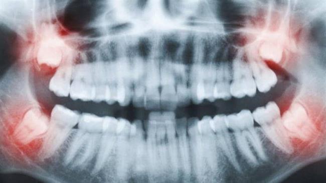 بررسی وضعیت دندان عقل