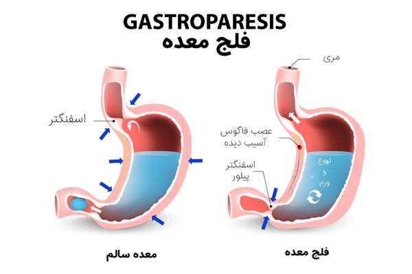 بیماری فلج معده چیست