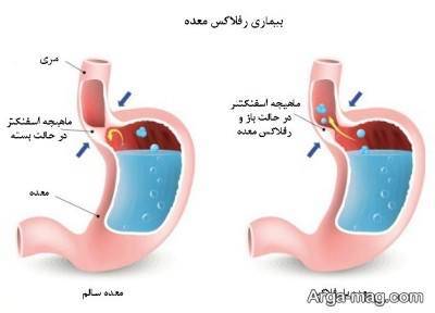 چگونگی اثر گذاری رفلاکس معده