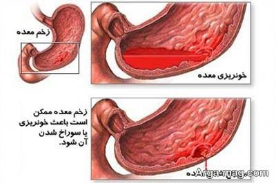 چند روش درمان خونریزی معده