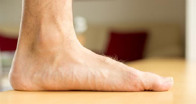 درمان صافی کف پا  در بزرگسالان به علت از بین رفتن قوس طولی مفاصل پا