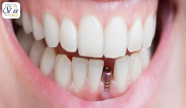 چگونه دندان هایی سالم و زیبا داشته باشیم ؟