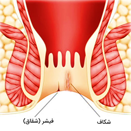 درمان شقاق