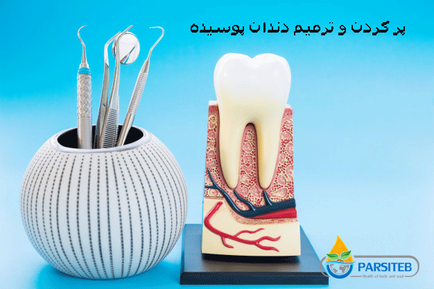 عمل زیبایی دندان: پرکردن و ترمیم دندان پوسیده