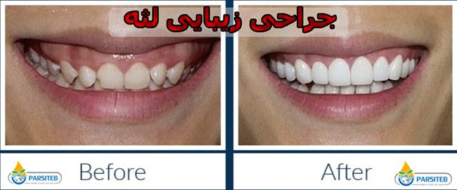 عمل زیبایی دندان: جراحی زیبایی لثه
