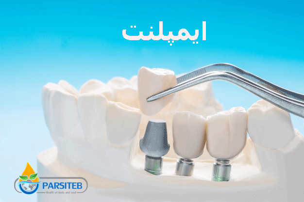عمل زیبایی دندان: دندان مصنوعی کامل