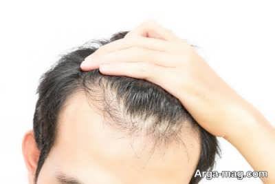 مهمترین دلایل ریزش مو در مردان و زنان را بهتر بشناسید