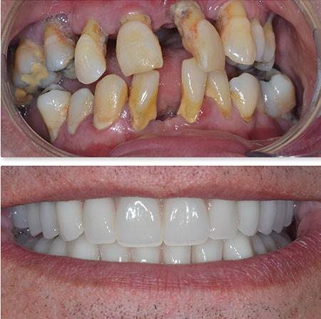 مزیت های ایمپلنت دندان