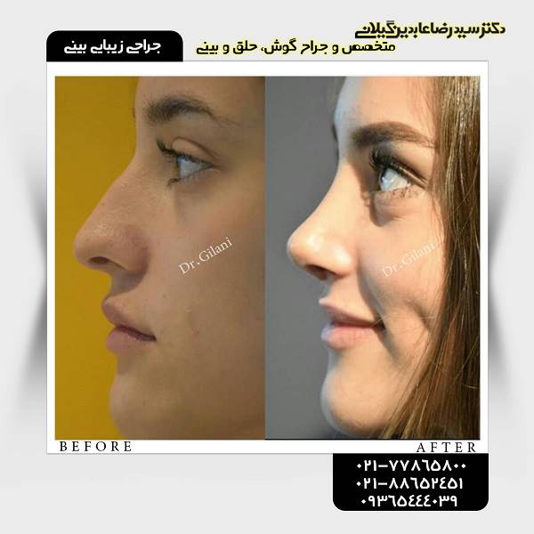 جراحی زیبایی بینی؛ قیمت سال 98 و جدیدترین انواع آن