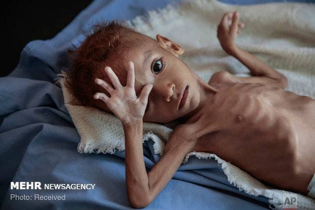 یونیسف: یک سوم کودکان زیر 5 سال جهان دچار سوءتغذیه هستند