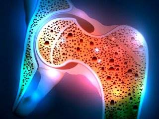 پوکی استخوان ؛ از علت تا درمان