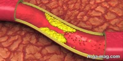 درمان چربی خون و آنچه باید درباره علائم و روش های کاهش طبیعی چربی خون بدانید