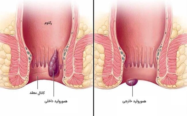 لیزر بهترین درمان بواسیر(هموروئید)، شقاق، فیستول و کیست مویی