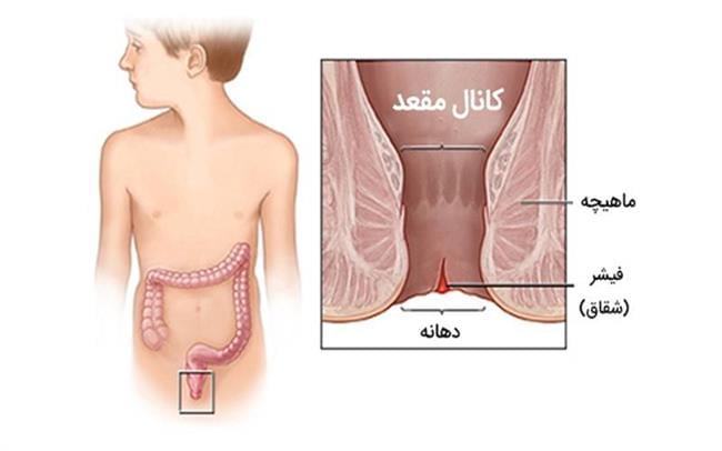 لیزر بهترین درمان بواسیر(هموروئید)، شقاق، فیستول و کیست مویی