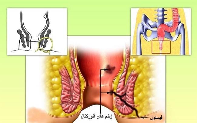 لیزر بهترین درمان بواسیر(هموروئید)، شقاق، فیستول و کیست مویی